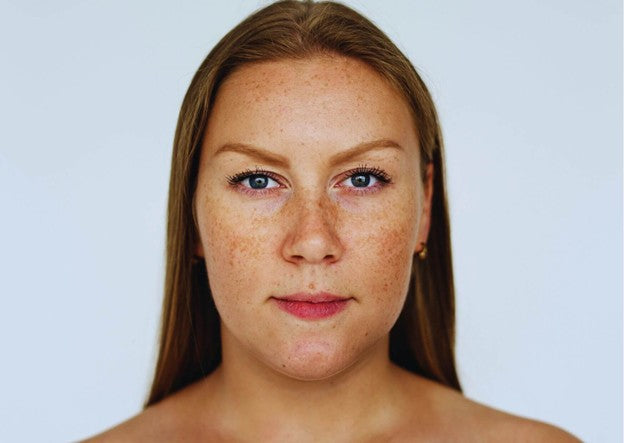 فرط التصبغات: الدليل الكامل للتخلص منه وأسبابه.