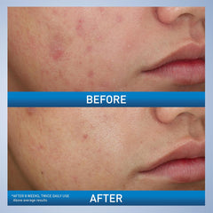 Cerave Acne Foaming Cream Wash 150 ml