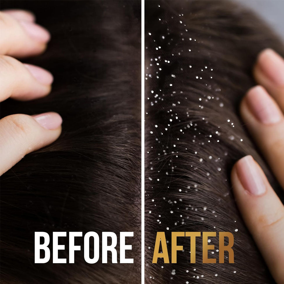 بانتين شامبو علاج للقشرة 2*1 390 مل |  صيدلية.كوم.