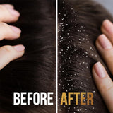 بانتين شامبو علاج للقشرة 2*1 390 مل |  صيدلية.كوم.