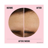 بيس اوت لمكافحة التجاعيد. لصقات حمض الهيالورونيك بالإبر الدقيقة مع الريتينول والببتيدات وفيتامين سي لتنعيم الخطوط والتجاعيد 6 لصقات