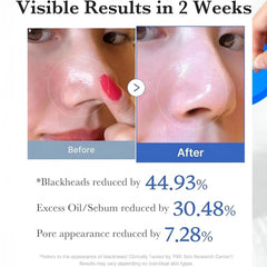 ميديكيوب مسحات زيرو بور لتضيق المسام وتنظيف البشرة 70 قطعة