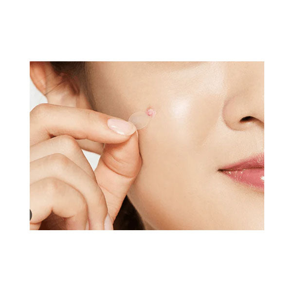 كوسركس لصقات حب الشباب