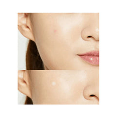 كوسركس لصقات حب الشباب