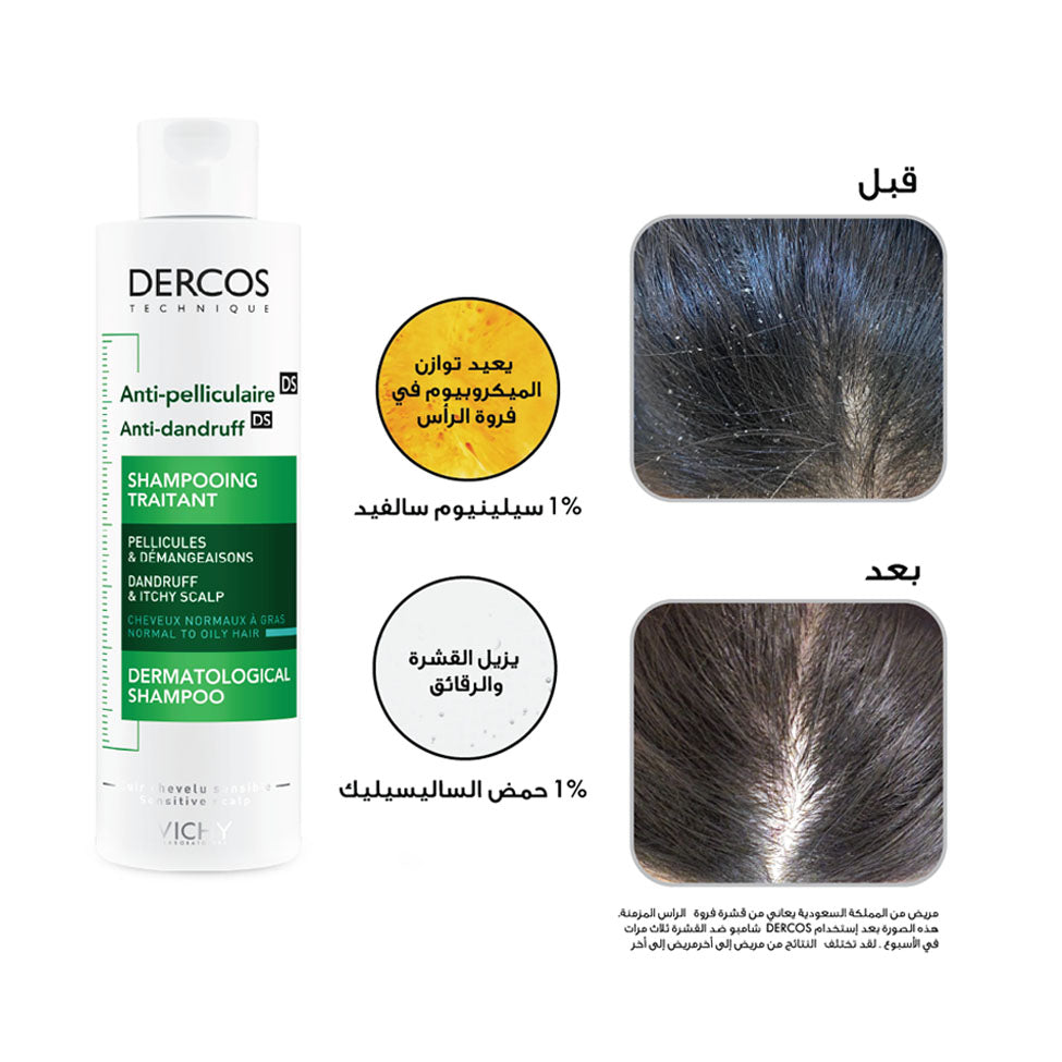 فيتشي شامبو للقشرة والحكة للشعر الجاف