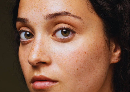 أسباب البقع البنية في الجسم والوجه: دليل شامل للعناية بالبشرة.