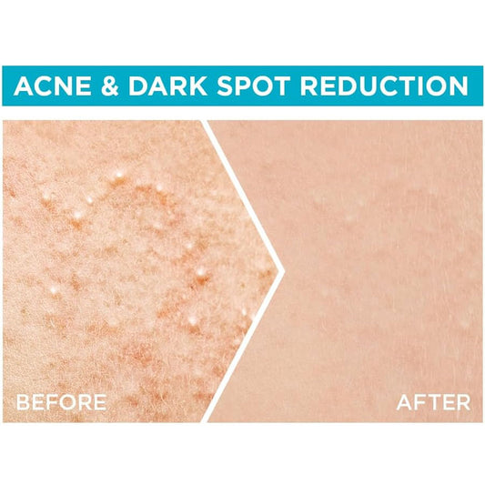 Garnier Facial Serum Rapid Purification Vitamin C for acne-prone skin 30 ml