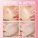 Purederm Care Gel For Clear Skin Free Of Pigmentation 20 ml