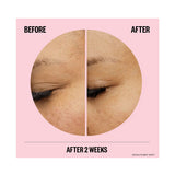 Peace Out to combat wrinkles. Microneedle Hyaluronic Acid Patches with Retinol, Peptides and Vitamin C to Smooth Lines and Wrinkles 6 Patches